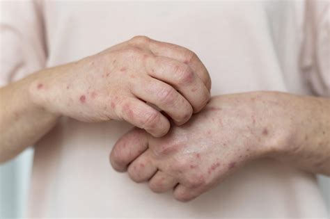 top post herpetic neuralgia treatment vizag pain clinic