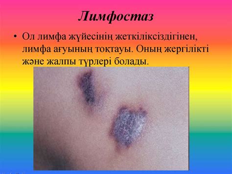 Лимфа айналымының бұзылуы: лимфа түзілуінің бұзылуы. Лимфедема ...