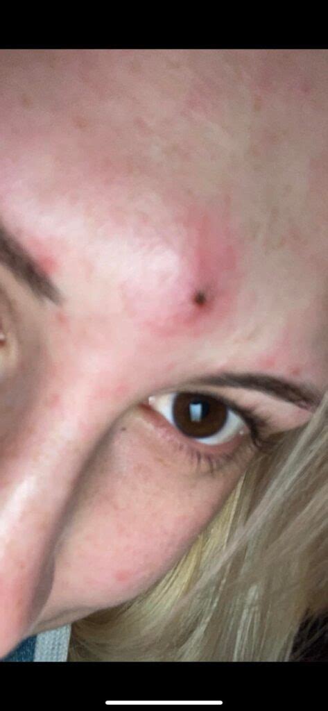 mengatasi bisul  perlu  ketahui kordanews