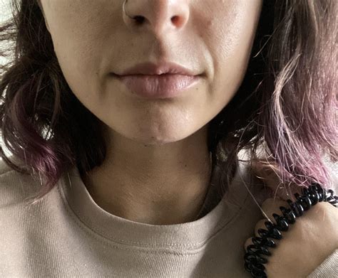 smile line fillers before and after 3