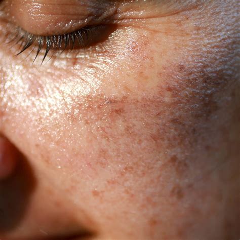post inflammatory hyperpigmentation