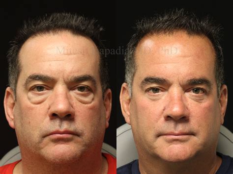 Eyelid Surgery & Blepharoplasty | Boston Eyelid Surgery