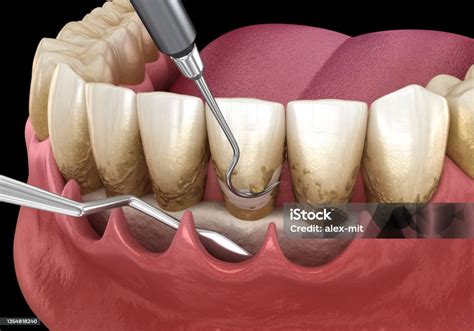 Como É O Procedimento De Curetagem - Foto de Curetagem Aberta Dimensionamento E Planejamento Radicular ...