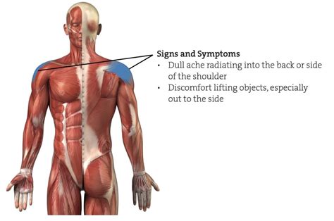 Rotator Cuff Strain Climbing Rehabilitation Program - The Climbing Doctor