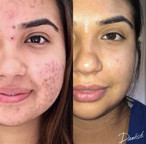 Before & After Photos - Acne, Hair Removal, Botox, and more — Danesh ...