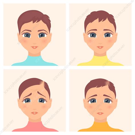 Female alopecia stages, illustration - Stock Image - F037/0565 ...