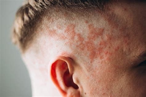 atopic dermatitis     face