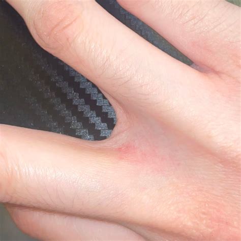 red itchy spot on palm of hand 1