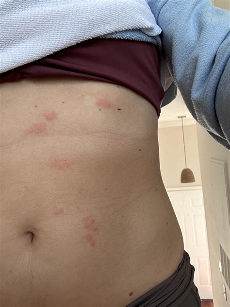What is this rash? 27F. Woke up with it, only on one side of stomach