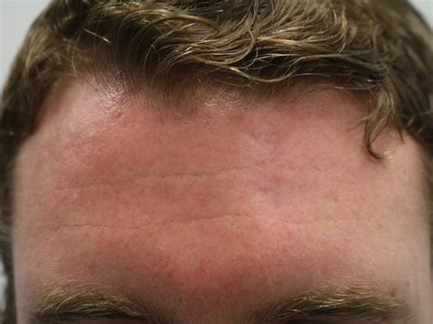 Scars 08 | Brisbane Skin, Dermatologist Brisbane. Medical, surgical ...