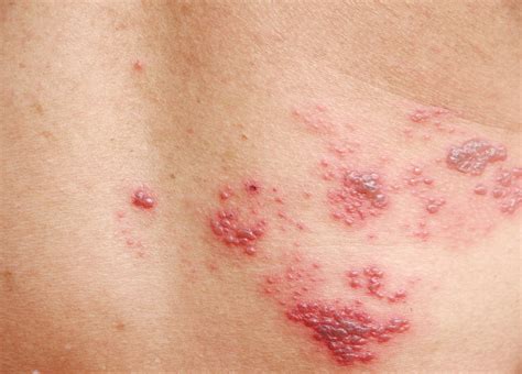 Shingles – How to spot the typical symptoms - DocFinder.co.uk