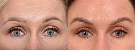 eyebrow hair transplant    pictures case