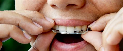 how long do you have to wear retainers