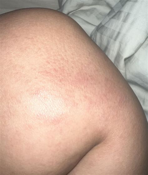 Lichen Simplex Chronicus : r/eczema