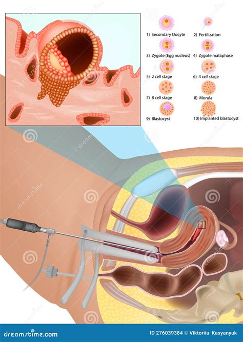 Embryo Transfer Procedure. Invitro Fertilization Process.in Vitro IVF