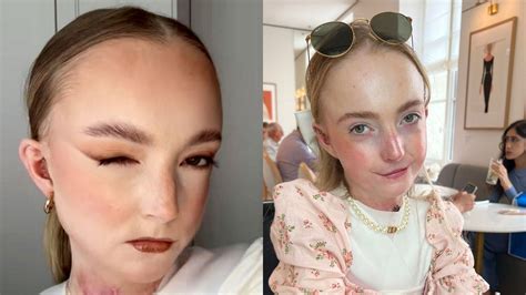 Woman has skin so fragile it's as delicate as a butterfly's wings
