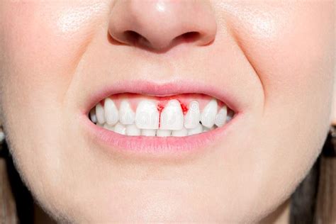 woman mouth  bleeding gums periodontal disease stock image image