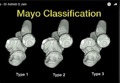 Coronoid Process Fracture Fixation — OrthopaedicPrinciples.com