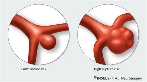 Intracranial Aneurysm Nonruptured Cerebral Aneurysm What You Need To