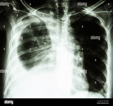 film chest  ray pa upright show pleural effusion   lung due