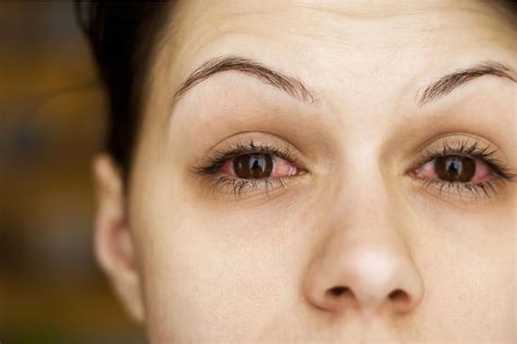 Red Eyes: Causes, Complications, and How to Treat | MyVision.org