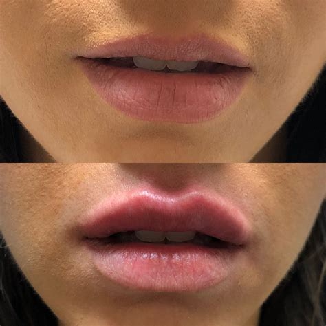 lip injections at home