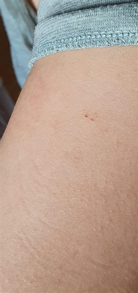 Bat Bites