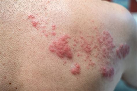 Shingles - Aura Dermatology