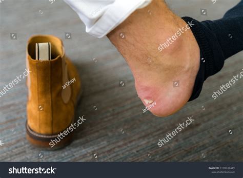 503 Chafed Skin Images, Stock Photos & Vectors | Shutterstock