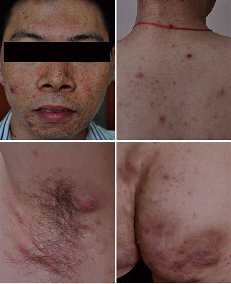 SAPHO syndrome causes, symptoms, diagnosis & treatment