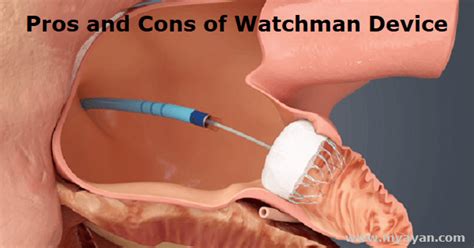 Pros and Cons of Watchman Device - Medical device placed