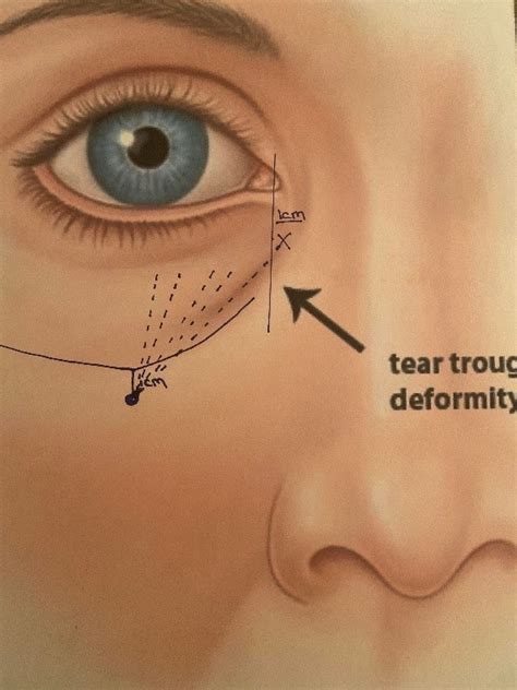 tear troughs enhance  training academy