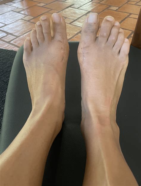 4 weeks post bunion surgery as a runner before and after pictures : r