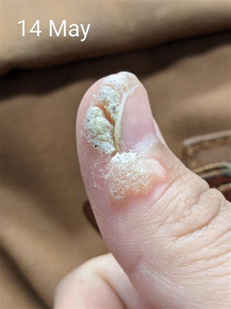 Progress pics, periungual wart. Is the end in sight? : r/Warts