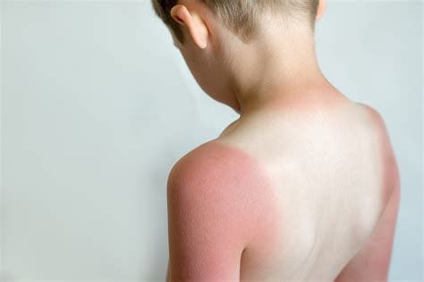 sunburn on face treatment 4