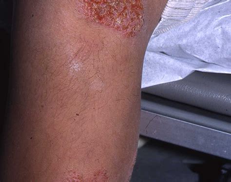 Nummular Dermatitis | School of Medicine