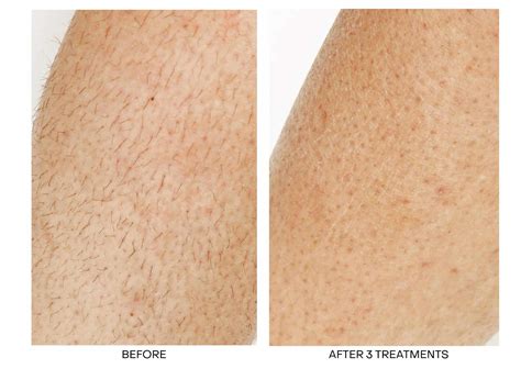 hair removal near me 8