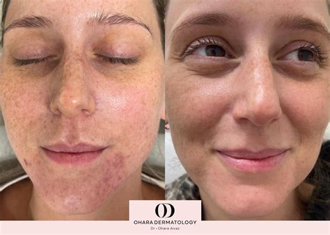 scar revision ohara dermatology