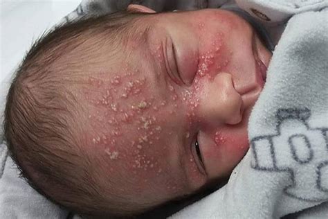 Herpes No Rosto Do Bebe