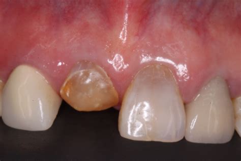 Implants in the Aesthetic Zone | Canton, OH | Replace Front Teeth