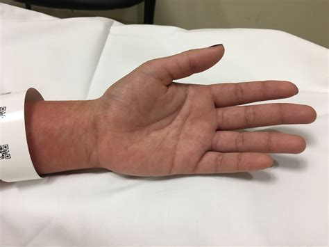 Morbilliform Rash Ebv