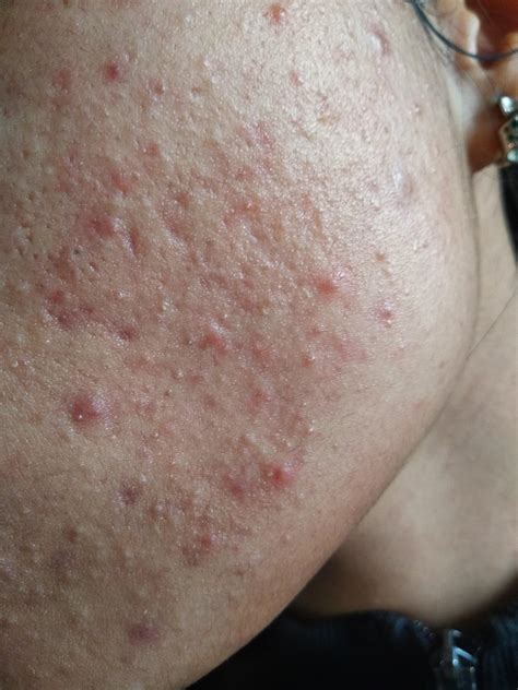 I have been dealing with acne breakouts every now and then. This time