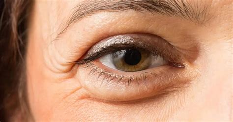 Swollen lower eyelid: causes, possible diseases, treatment methods | Health