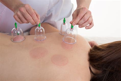 What is Cupping and what are the BENEFITS — Proformance Clinics