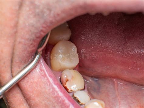 mandibular  premolar stock   royalty  stock