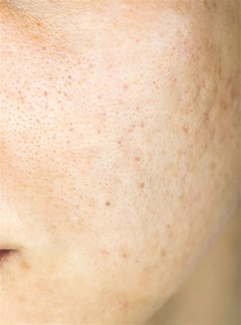 Acne Scars in Singapore - Regen Clinic | Secret RF Singapore