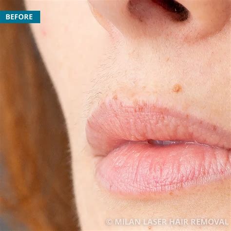 Face Before & After Photos of Laser Hair Removal | Milan Laser in Salt ...