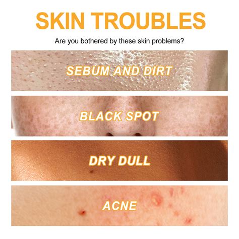 This Natural Remedy Clears Big Blackheads Like Magic