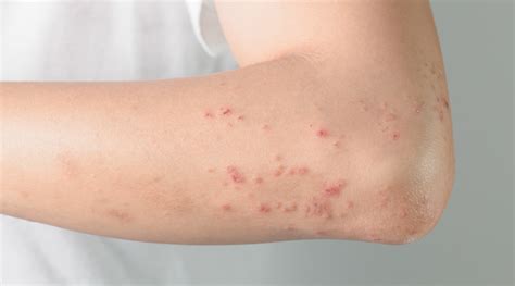 Skin Bumps: Different Types, Causes, And More - HealthKart