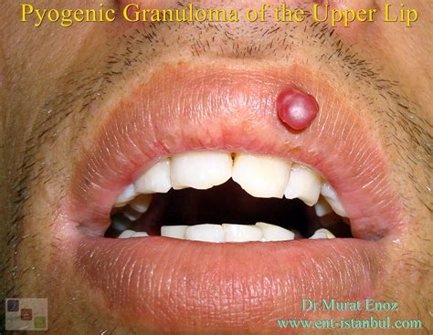 pyogenic granuloma   upper lip lobular capillary hemangioma